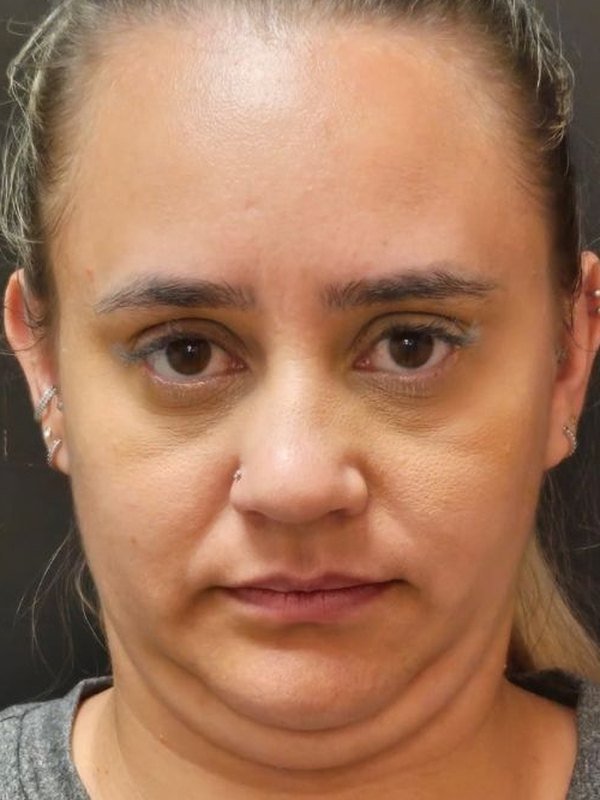 Antes: lipo de papada, de frente. Paciente da Dra. Silvia Cuartero