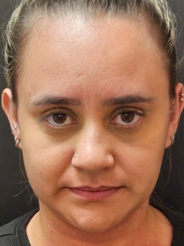 Depois: lipo de papada, de frente. Paciente da Dra. Silvia Cuartero
