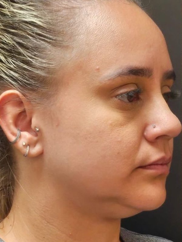 Antes: lipo de papada, três quartos. Paciente da Dra. Silvia Cuartero