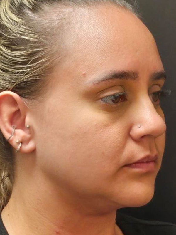 Depois: lipo de papada, três quartos. Paciente da Dra. Silvia Cuartero