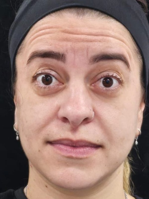 Antes: toxina botulínica, testa, ao elevar as sobrancelhas. Paciente da Dra. Silvia Cuartero