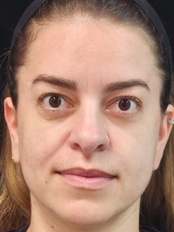 Depois: toxina botulínica, testa, ao elevar as sobrancelhas. Paciente da Dra. Silvia Cuartero