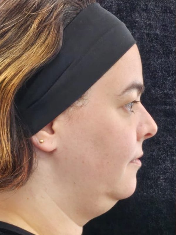 Antes: lipo de papada e lipo facial, perfil. Paciente da Dra. Silvia Cuartero