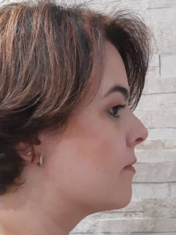 Depois: lipo de papada e lipo facial, perfil. Paciente da Dra. Silvia Cuartero