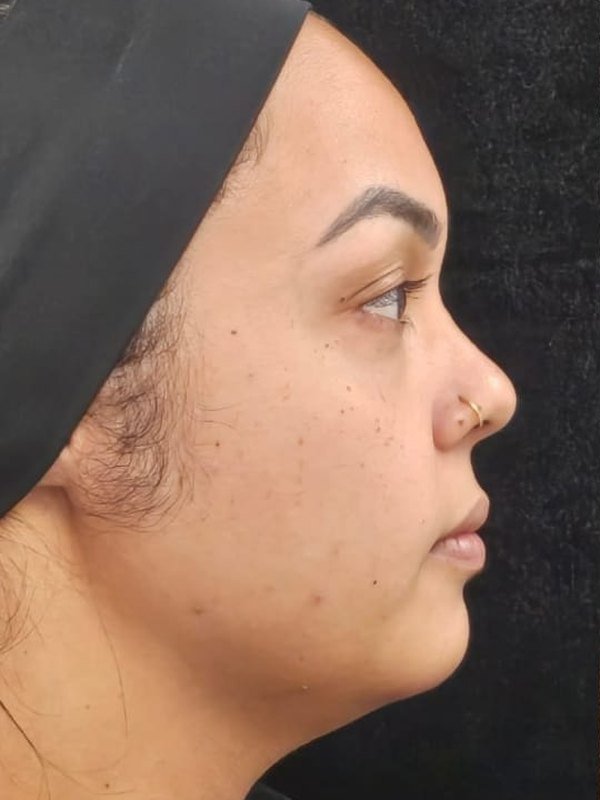 Antes: lipo de papada, lipo facial e bichectomia, no mesmo dia, perfil. Paciente da Dra. Silvia Cuartero