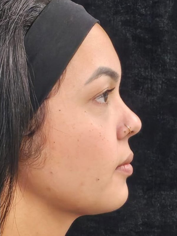 Depois: lipo de papada, lipo facial e bichectomia, no mesmo dia, perfil. Paciente da Dra. Silvia Cuartero