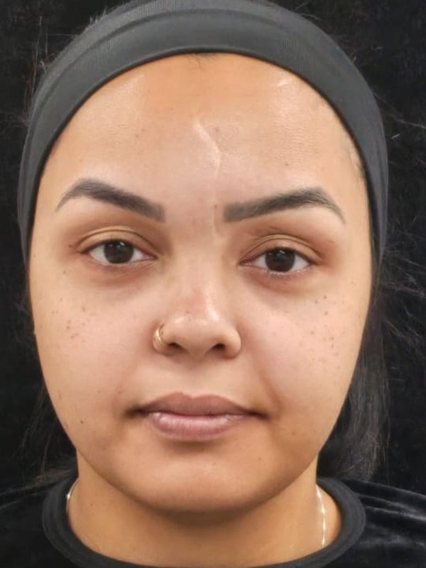 Antes: lipo de papada, lipo facial e bichectomia, no mesmo dia, de frente. Paciente da Dra. Silvia Cuartero