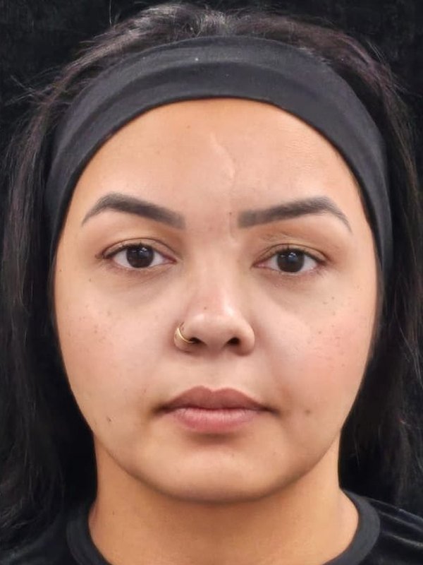 Depois: lipo de papada, lipo facial e bichectomia, no mesmo dia, de frente. Paciente da Dra. Silvia Cuartero