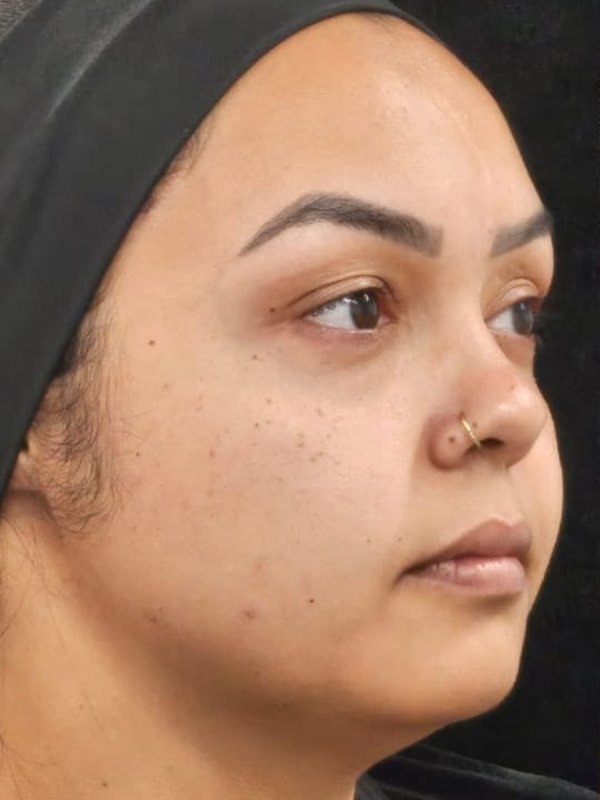 Antes: lipo de papada, lipo facial e bichectomia, no mesmo dia, três quartos. Paciente da Dra. Silvia Cuartero