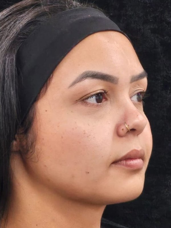 Depois: lipo de papada, lipo facial e bichectomia, no mesmo dia, três quartos. Paciente da Dra. Silvia Cuartero