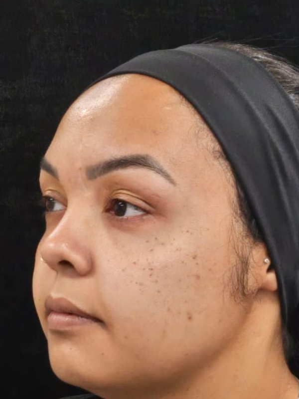 Antes: lipo de papada, lipo facial e bichectomia, no mesmo dia, três quartos, do outro lado. Paciente da Dra. Silvia Cuartero