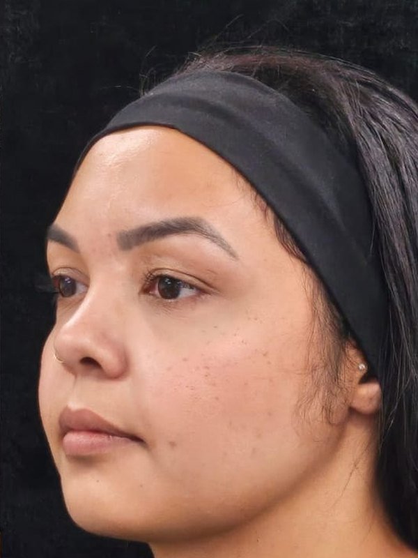 Depois: lipo de papada, lipo facial e bichectomia, no mesmo dia, três quartos, do outro lado. Paciente da Dra. Silvia Cuartero